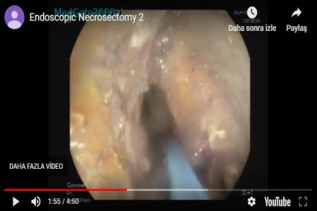Endoscopic necrosectomy